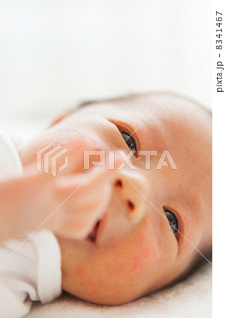 新生児にきび 新生児ニキビの写真素材