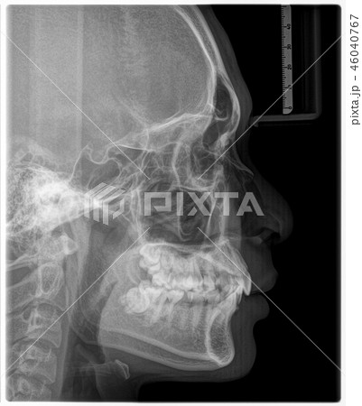 デンタル 歯科 骨格 X線の写真素材 - PIXTA