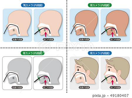 内視鏡検査のイラスト素材 内視鏡検査のイラスト素材