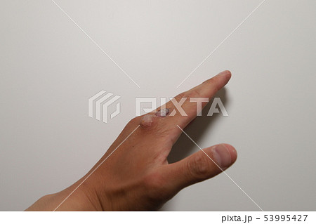 イボ治療 指の写真素材 - PIXTA