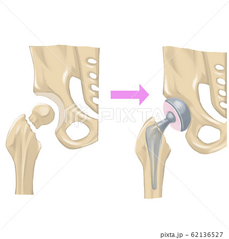 人工股関節のイラスト素材