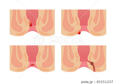 いぼ痔のイラスト素材 - PIXTA