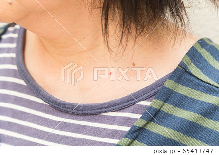 首いぼの写真素材 - PIXTA