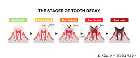 虫歯の進行のイラスト素材
