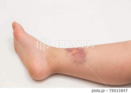 皮下出血の写真素材 - PIXTA