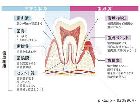歯周病のイラスト素材
