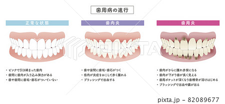 歯周病の写真素材