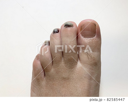 内出血 爪 足 足指の写真素材
