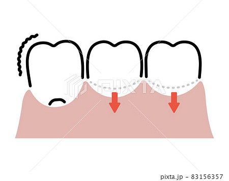 歯茎下がりのイラスト素材
