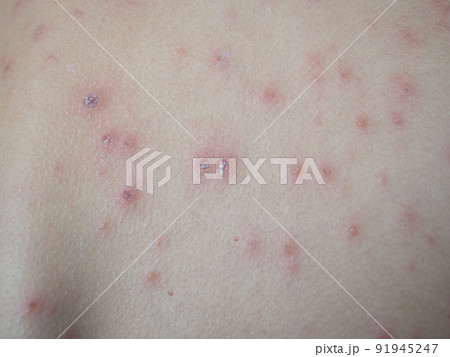 Upper back of young woman contracted chickenpox and red rash